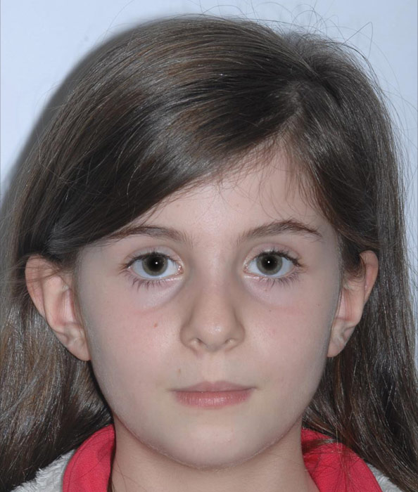 caso clinico orthotropics antes y despues caso clinico orthotropics antes y despues