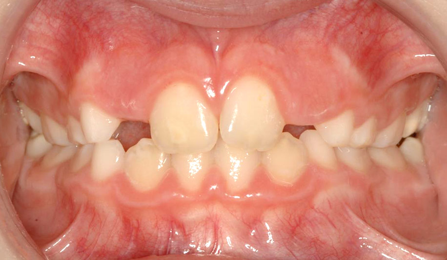 caso clinico orthotropics antes y despues caso clinico orthotropics antes y despues