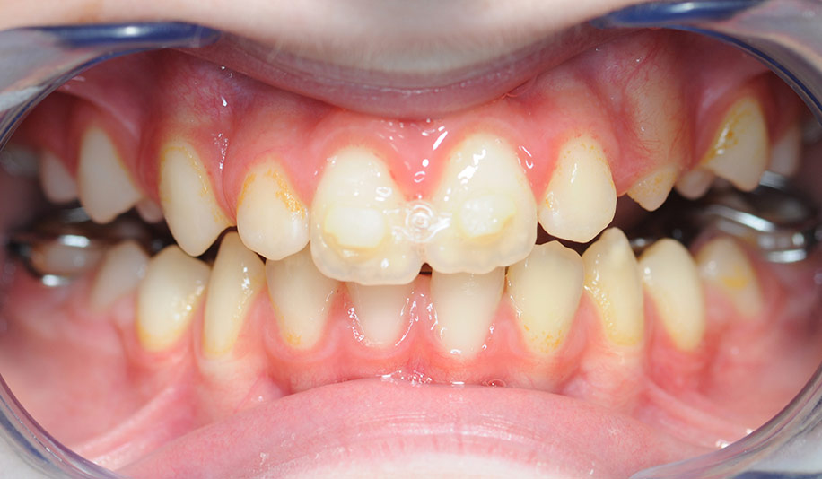 caso clinico orthotropics antes y despues caso clinico orthotropics antes y despues