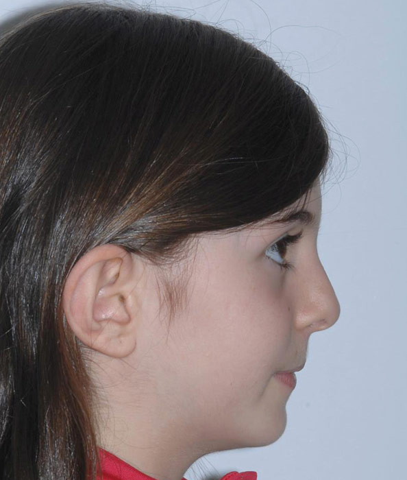 caso clinico orthotropics antes y despues caso clinico orthotropics antes y despues