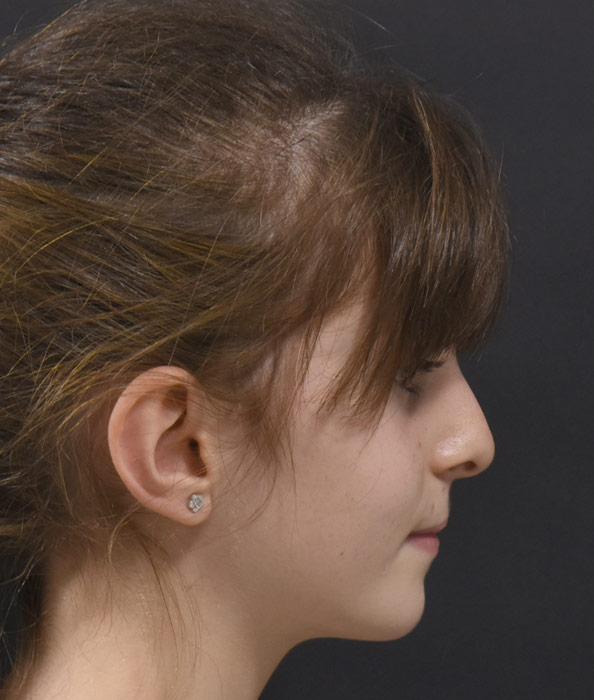 caso clinico orthotropics antes y despues caso clinico orthotropics antes y despues